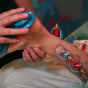 Reflexology with Cupping