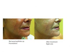 Radio Frequency Treatment Series Special