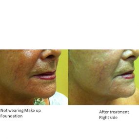 Radio Frequency Treatment Series Special