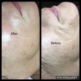 Facial Cupping